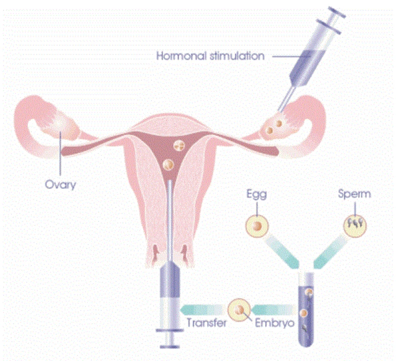 clínica ginecológica para fertilização in vitro