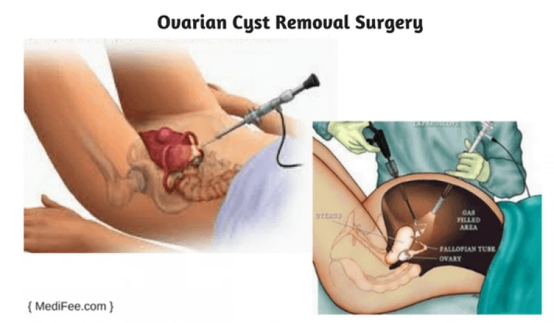 clínica para cirurgia para cistos de de ovário