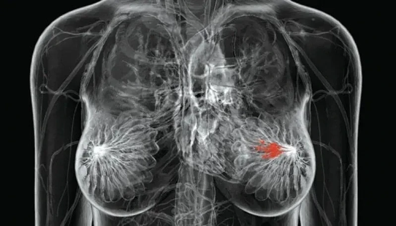 mastologista para nódulo mamário