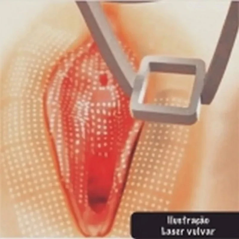 sessão de laserterapia​ vaginal