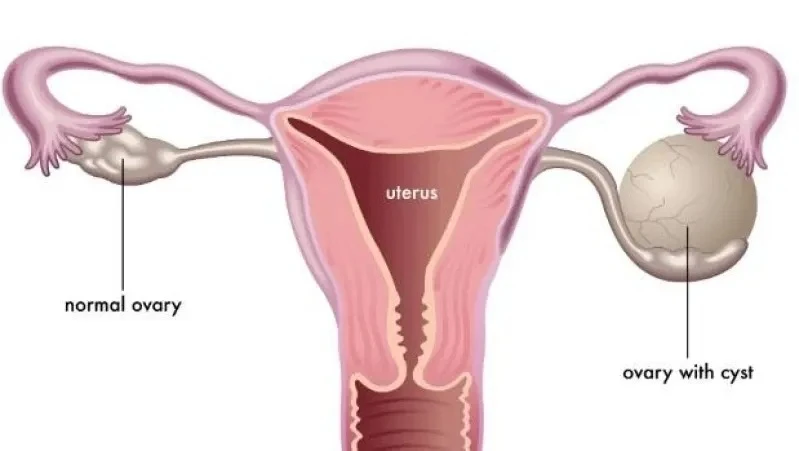 tratamento para câncer feminino